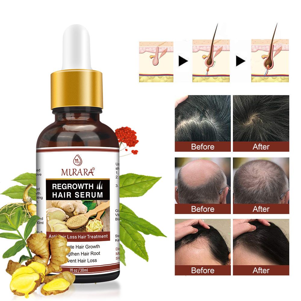 Elecsop Hair Growth Serum, Ginger Hair Growth Treatment Promotes Hair Regrowth for Men Women